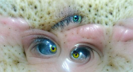 Eye with Sectoral Heterochromia Close-up