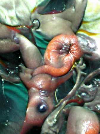 Fetal discharge