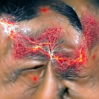 Exploding Blood Vessels on Forehead: Intense Close-Up