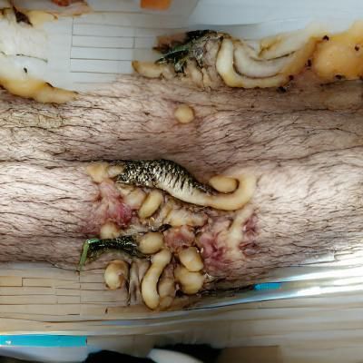 Unsettling Maggots Embedded in Leg: Trypophobia Trigger