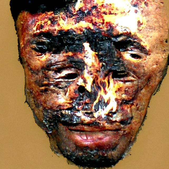 Man with Severely Burned and Scarred Face