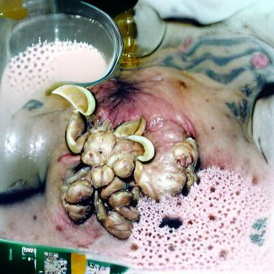 Teratoma trypophic cancer sour milk
