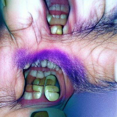 purple tooth syndrome