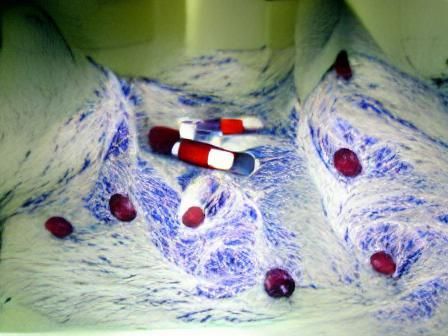 clinical trial