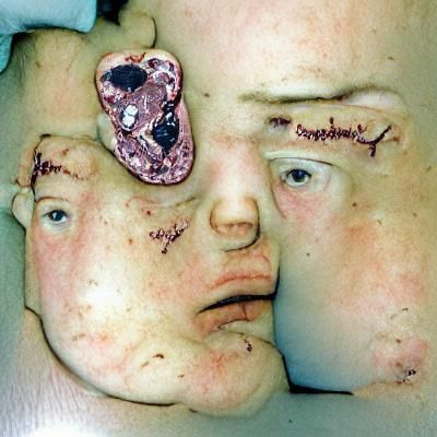 Stoneman syndrome