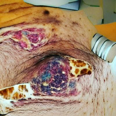 Where did my cancer go?