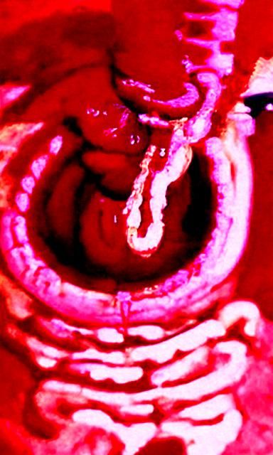 internal hemorrhaging in the large intestine