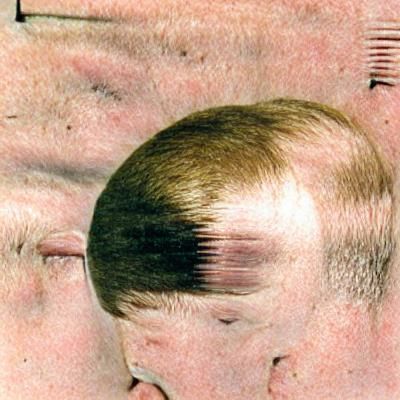 flat head syndrome